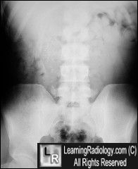 Ossification in scar